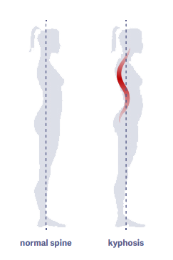 woman with normal spine and woman with a spine with kyphosis